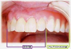 �o���v���X�g�̓��ꎕ